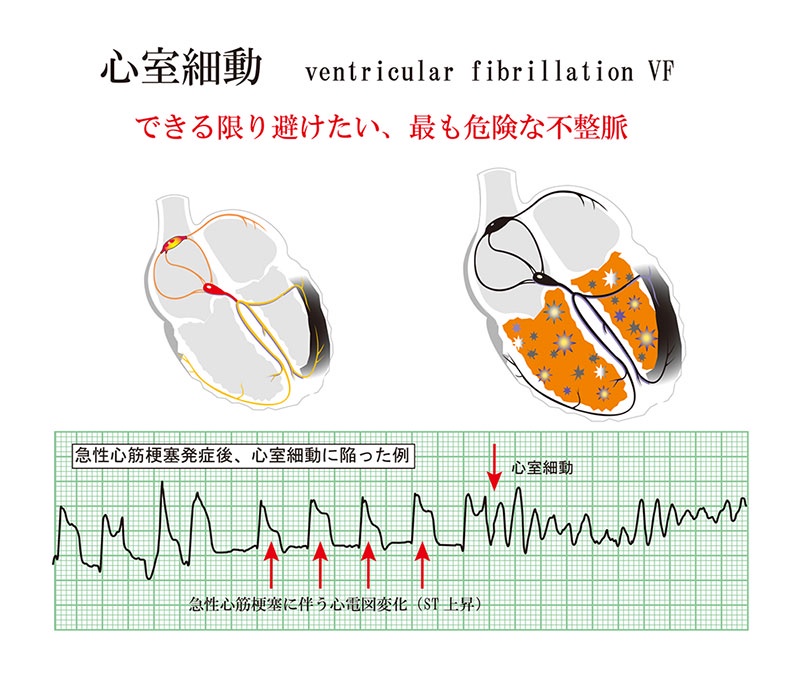 心室細動.jpg